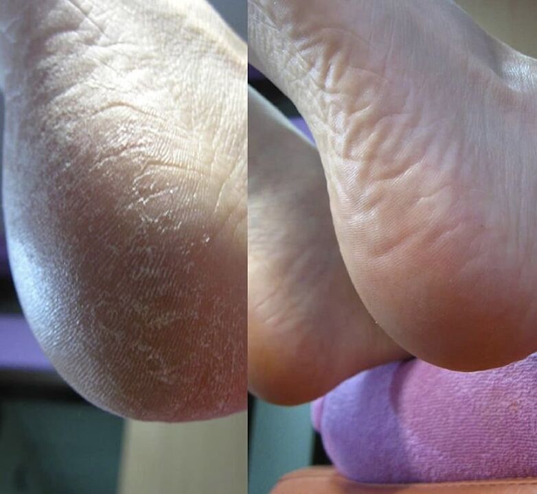 Foto del tallone del piede prima e dopo l'uso della crema Zenidol
