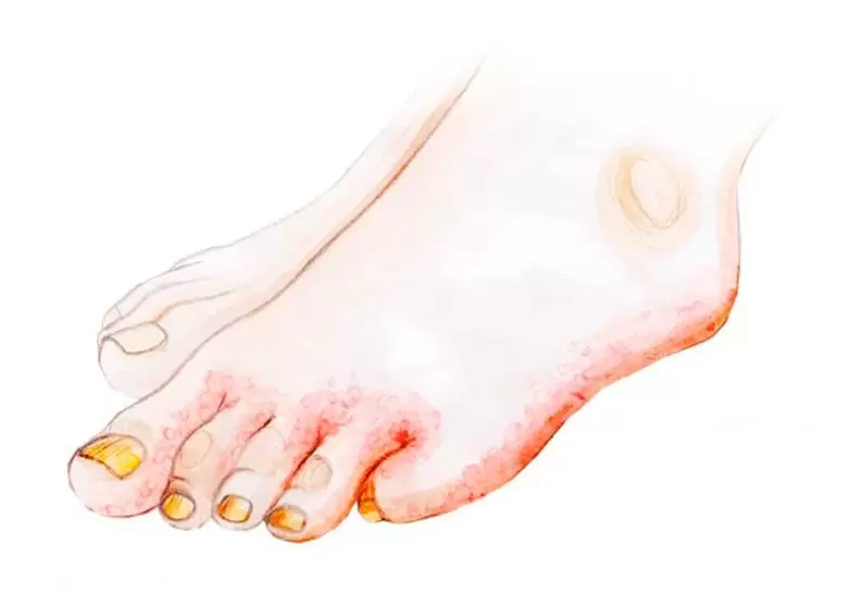 Fungo sulle dita dei piedi e come applicare la crema Zenidol