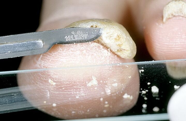 raschiamento delle unghie per diagnosticare il fungo