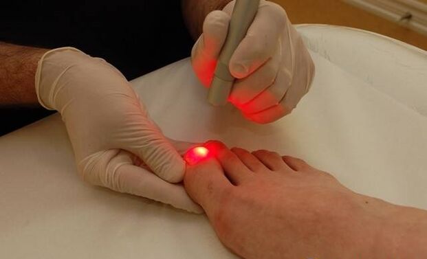 trattamento laser per il fungo dell'unghia del piede