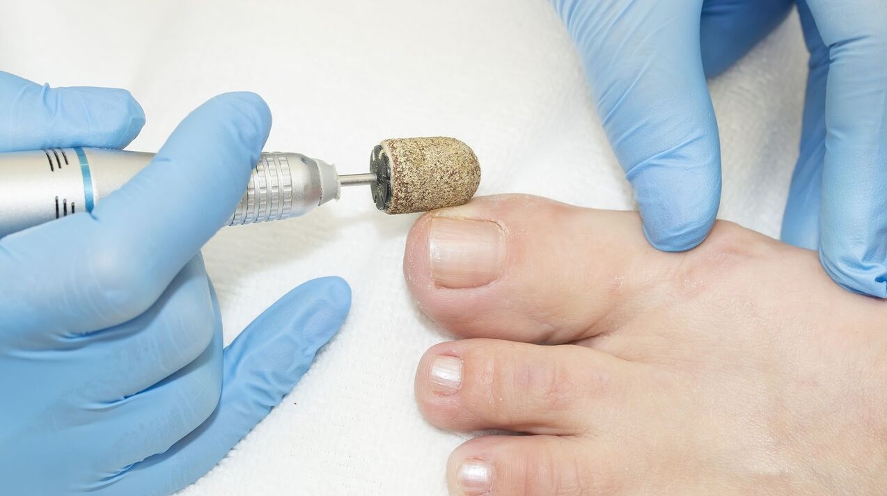 trattamento hardware del fungo sulle unghie dei piedi