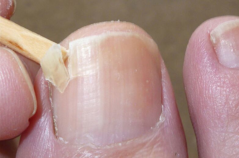 Le unghie danneggiate sono un fattore di rischio per le infezioni fungine