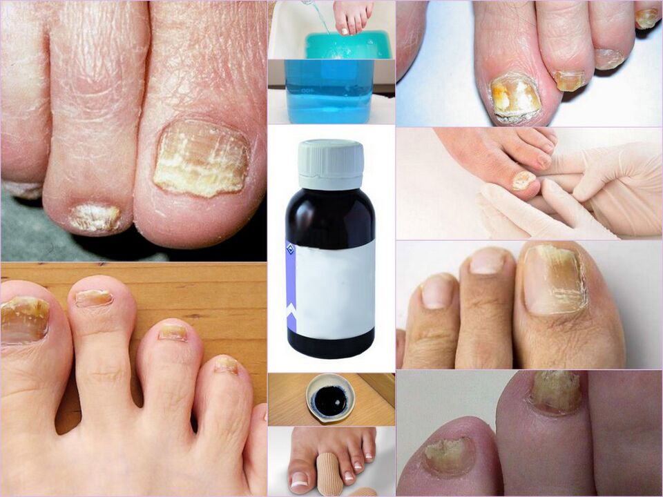 medicinali per i funghi delle unghie dei piedi