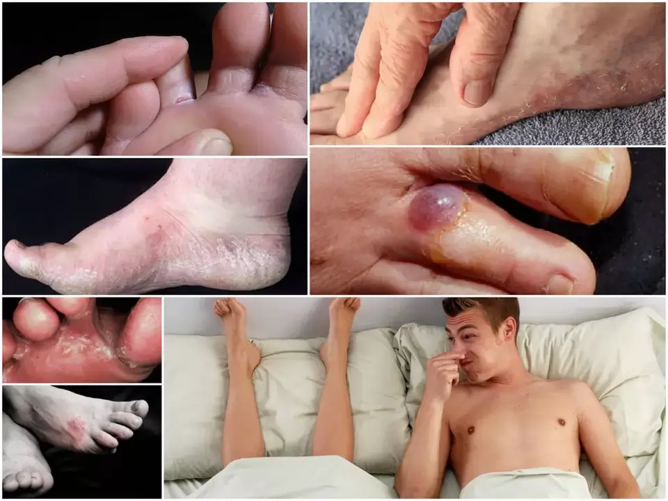 Principali segni di funghi ai piedi