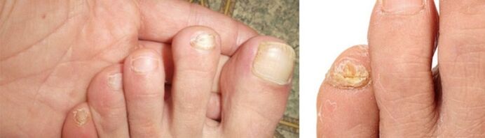 foto di manifestazioni di funghi sulle unghie dei piedi