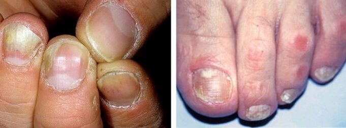 manifestazioni di un'infezione fungina sulle unghie