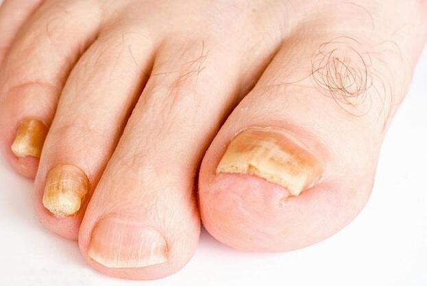 che aspetto ha il fungo dell'unghia del piede