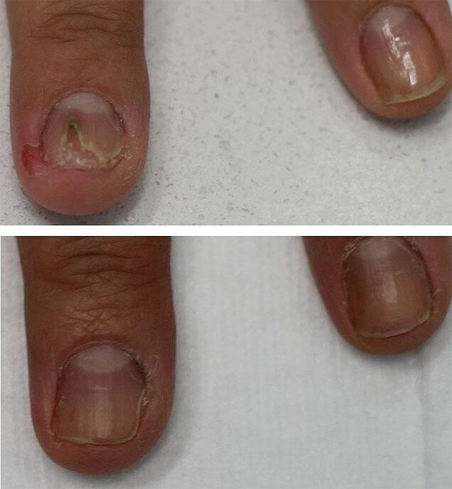 infezione fungina delle unghie dei piedi
