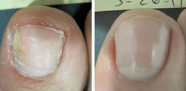 prima e dopo il trattamento del fungo delle unghie