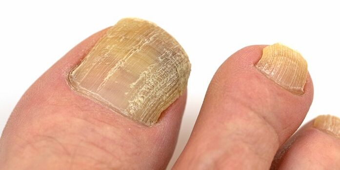 danni alle unghie con infezione fungina avanzata