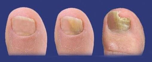 fasi di sviluppo del fungo sulle unghie dei piedi