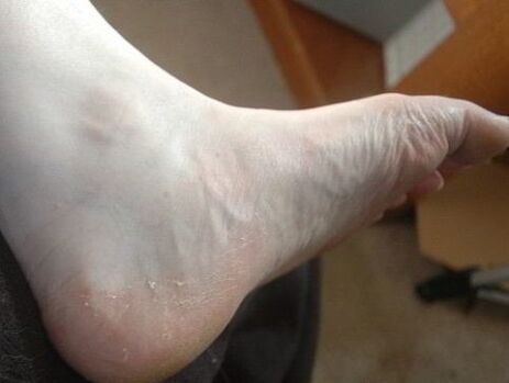desquamazione del piede della gamba come segno di infezione fungina