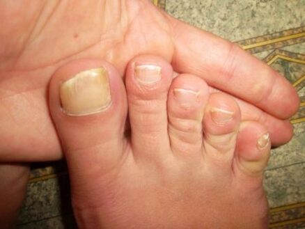 unghie dei piedi colpite da funghi